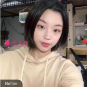 眼睛不夠大，我找武漢藝星整形醫(yī)院做眼綜合，擁有了大雙眼