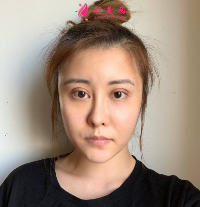 武漢米蘭整形醫(yī)院王楷雙眼皮