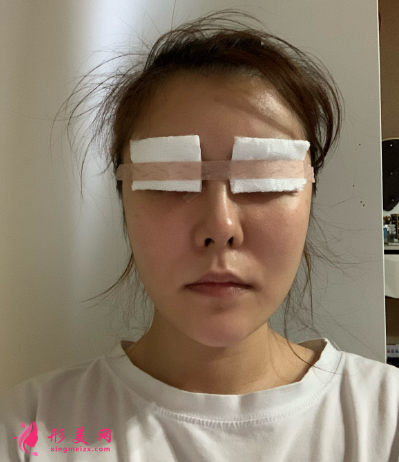 武漢米蘭整形醫(yī)院王楷雙眼皮