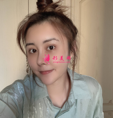 武漢米蘭整形醫(yī)院王楷雙眼皮