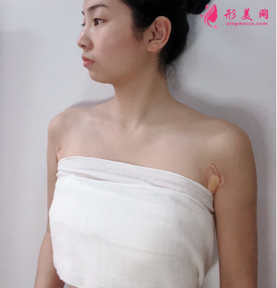 上海港華整形醫(yī)院呂金陵豐胸案例 上海港華整形醫(yī)院呂金陵豐胸案例