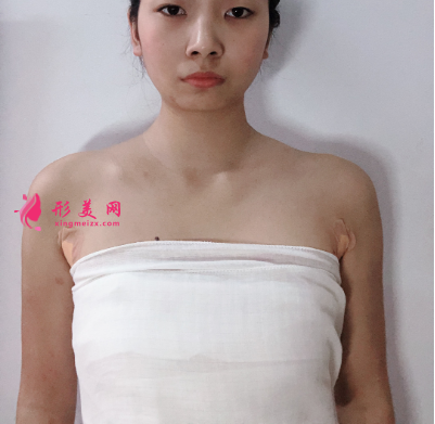 上海港華整形醫(yī)院呂金陵豐胸案例 上海港華整形醫(yī)院呂金陵豐胸案例