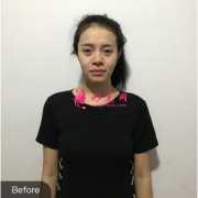 武漢卓美整形醫(yī)院做假體隆胸，術(shù)后性感美胸上線了