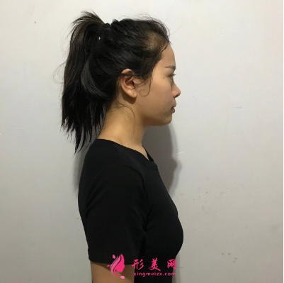 武漢一美彭義坤假體隆胸 武漢一美彭義坤假體隆胸