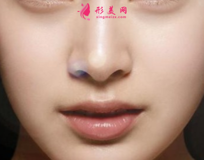 自體軟骨隆鼻效果可以保持多久
