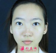 北京八大處靳小雷隆鼻效果怎么樣？看真人案例可參考!
