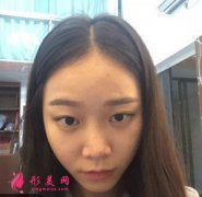 廣州美萊羅延平醫(yī)生隆鼻效果怎么樣？真人案例圖拿去借鑒！