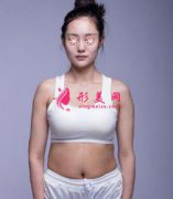 北京協(xié)和醫(yī)院整形腰腹吸脂案例，術(shù)后效果差別明顯！