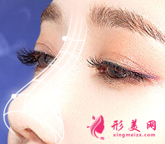假體隆鼻手術(shù)包膜攣縮要不要取出來