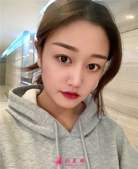 找八大處宗憲磊醫(yī)生做了雙眼皮手術(shù)，術(shù)后6個(gè)月恢復(fù)效果圖