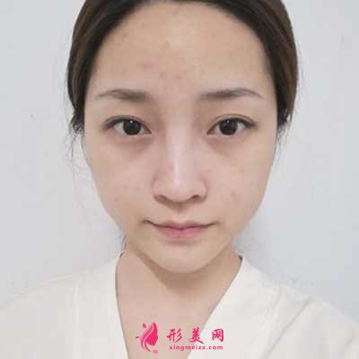 去北京麗都找曹衛(wèi)華醫(yī)生做鼻綜合整形手術(shù)前