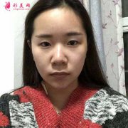 去成都華美紫馨找陳楊做全切雙眼皮，術(shù)后70天恢復(fù)效果對比圖