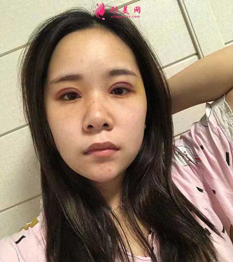 去成都華美紫馨做全切雙眼皮手術(shù)后