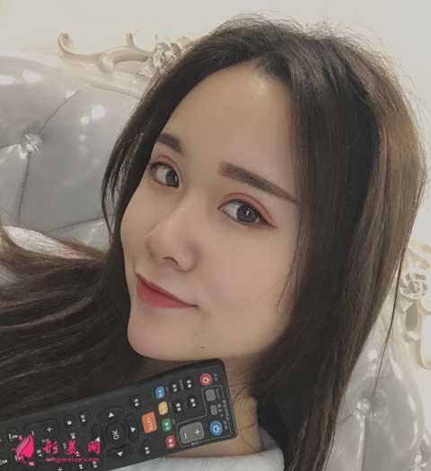去成都華美紫馨做全切雙眼皮手術(shù)后30天