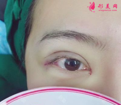 上海百達麗整形王維做雙眼皮怎么樣？60天術(shù)后效果對比真的好極了
