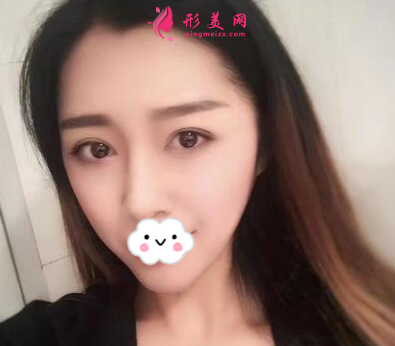 上海百達麗整形王維做雙眼皮怎么樣？60天術(shù)后效果對比真的好極了