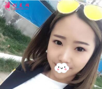 上海百達麗整形醫(yī)院做雙眼皮怎么樣？60天術(shù)后效果對比真的好極了