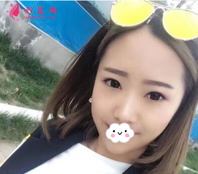 上海百達麗整形王維做雙眼皮怎么樣？60天術(shù)后效果對比真的好極了