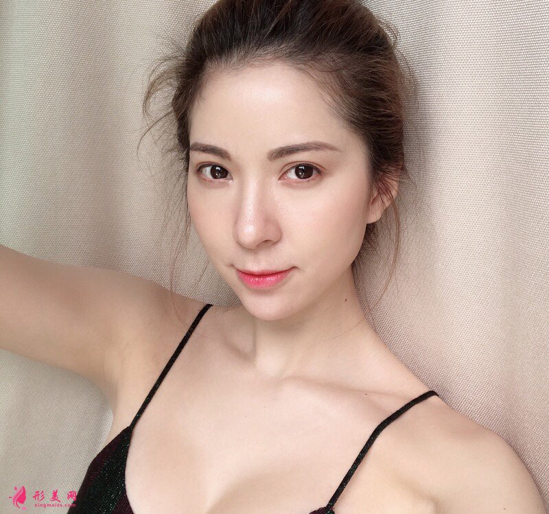 西安瑞麗郭永華醫(yī)師真人案例 隆胸90天前后對比圖分享