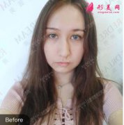 北京薇琳董香君雙眼皮修復(fù)靠譜嗎？案例恢復(fù)圖搶先一覽