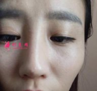 北京藝美王東醫(yī)生脂肪填充案例公開，術后太陽穴飽滿自然