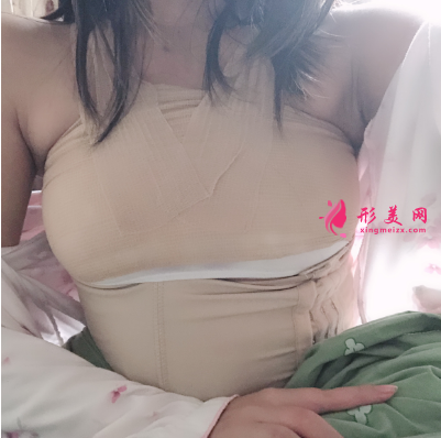 上海喜美整形醫(yī)院王會勇自體脂肪隆胸案例 上海喜美整形醫(yī)院王會勇自體脂肪隆胸案例