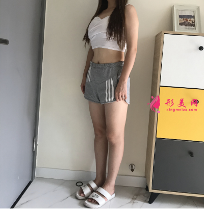 上海瑞芙臣整形醫(yī)院馬昌華大腿吸脂案例