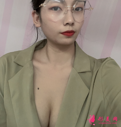 上海港華整形醫(yī)院呂金陵豐胸案例