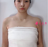 上海港華整形醫(yī)院的豐胸技術(shù)如何?性感身材讓我找到了愛(ài)情