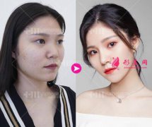 長沙雅美田芳斌做的鼻綜合,真的驚艷到了我自己