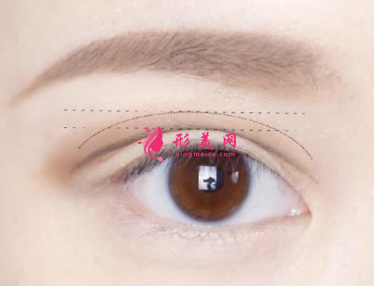 廣州美萊雙眼皮整形好嗎