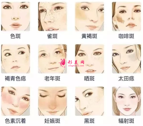 廣州美萊激光祛斑要多少錢呢
