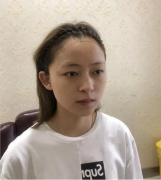成都恒博植發(fā)種植發(fā)際線術(shù)后半年恢復(fù)日記+實(shí)際效果展示