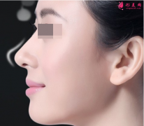 哪里隆鼻做得比較好呢？