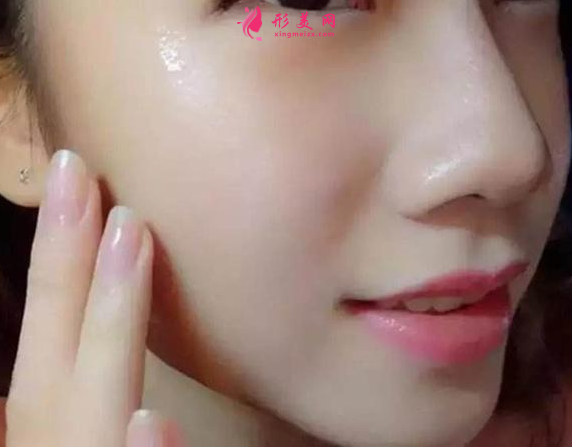 激光治療雀斑對(duì)皮膚有損傷嗎