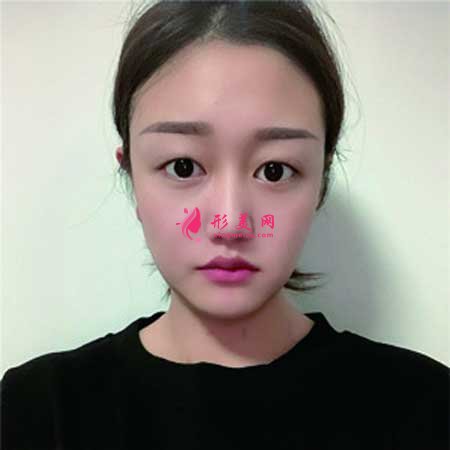 找八大處宗憲磊醫(yī)生做了雙眼皮手術，術后6個月恢復效果圖