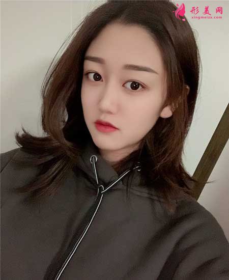 找八大處宗憲磊醫(yī)生做了雙眼皮手術，術后6個月恢復效果圖