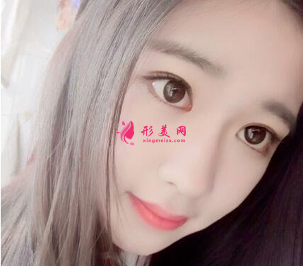 面部瘦臉我選擇了打瘦臉針，效果好明顯哦~