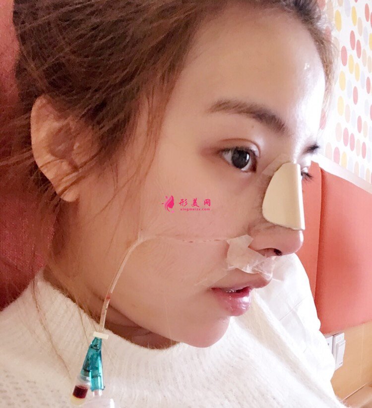 鼻頭鼻翼縮小手術(shù)案例，術(shù)后恢復(fù)全記錄！