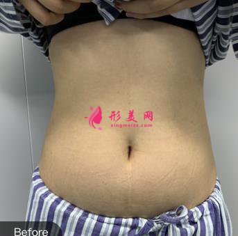 胖妞變型記：腰部吸脂術(shù)術(shù)后恢復(fù)全過程，看我72變~