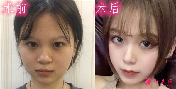 廈門安黛美醫(yī)療整形美容切開雙眼皮案例
