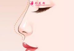 哪里做隆鼻手術(shù)會比較好？