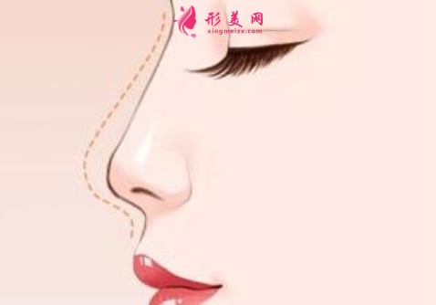 哪里做隆鼻手術(shù)會比較好