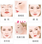 激光祛斑后會影響正常工作嗎？