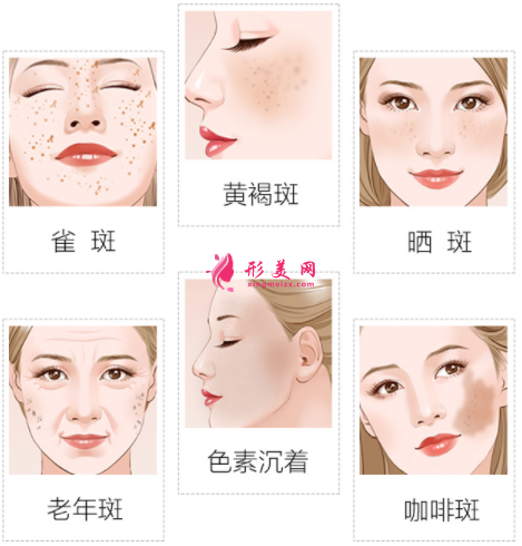 激光祛斑后會(huì)影響正常工作嗎