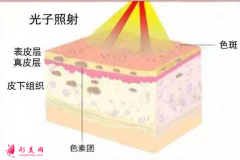 光子嫩膚需要做多少次？