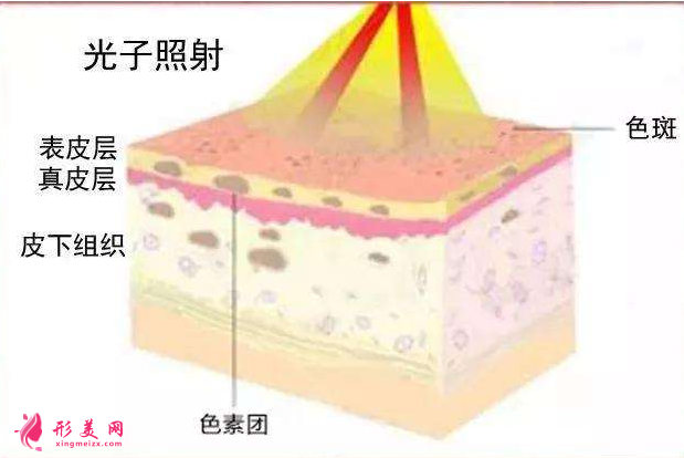 光子嫩膚需要做多少次
