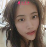 成都第二人民醫(yī)院整形科隆鼻案例術(shù)后對(duì)比圖奉上~真實(shí)自然