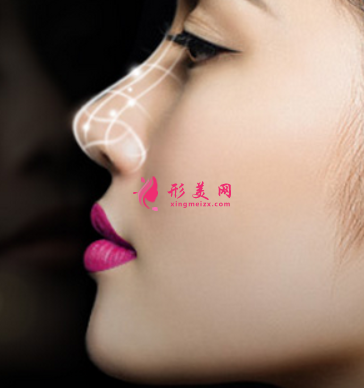 膨體隆鼻后要多久消腫