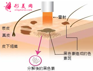 美萊王溪濤做激光祛斑如何